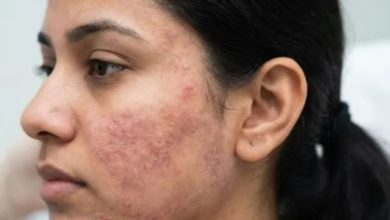Photo of मामूली रेडनेस या स्किन इन्फेक्शन का संकेत? डर्मेटोलॉजिस्ट ने बताया कैसे करें पहचान