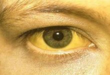 Photo of हरियाणा के इस जिले में 16 बच्चों में मिले पीलिया के लक्षण