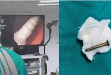 Photo of मौत के मुंह से लौटी 4 साल की अमायरा-आंत में फंसी थी 3 सेंटीमीटर लंबी कील