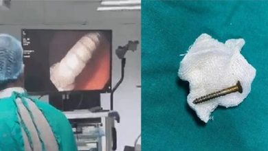 Photo of मौत के मुंह से लौटी 4 साल की अमायरा-आंत में फंसी थी 3 सेंटीमीटर लंबी कील