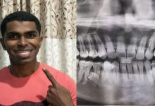 Photo of इस मलेशियाई व्यक्ति के मुंह में 32 नहीं बल्कि 42 दांत, बनाया वर्ल्ड रिकॉर्ड