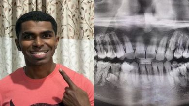 Photo of इस आदमी के मुंह में 32 नहीं, 42 दांत हैं, गिनीज वर्ल्ड रिकॉर्ड में हुआ शामिल