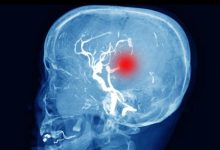 Photo of ब्रेन इंजरी के बाद ‘साइलेंट किलर’ बन सकता है हाइड्रोसिफलस